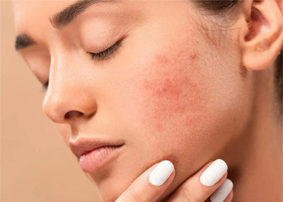 Dry Skin (Dark Spot)