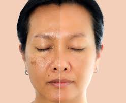Sunburn & Sun Damage