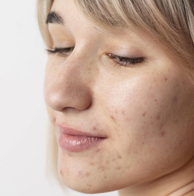 Acne (Pimples)